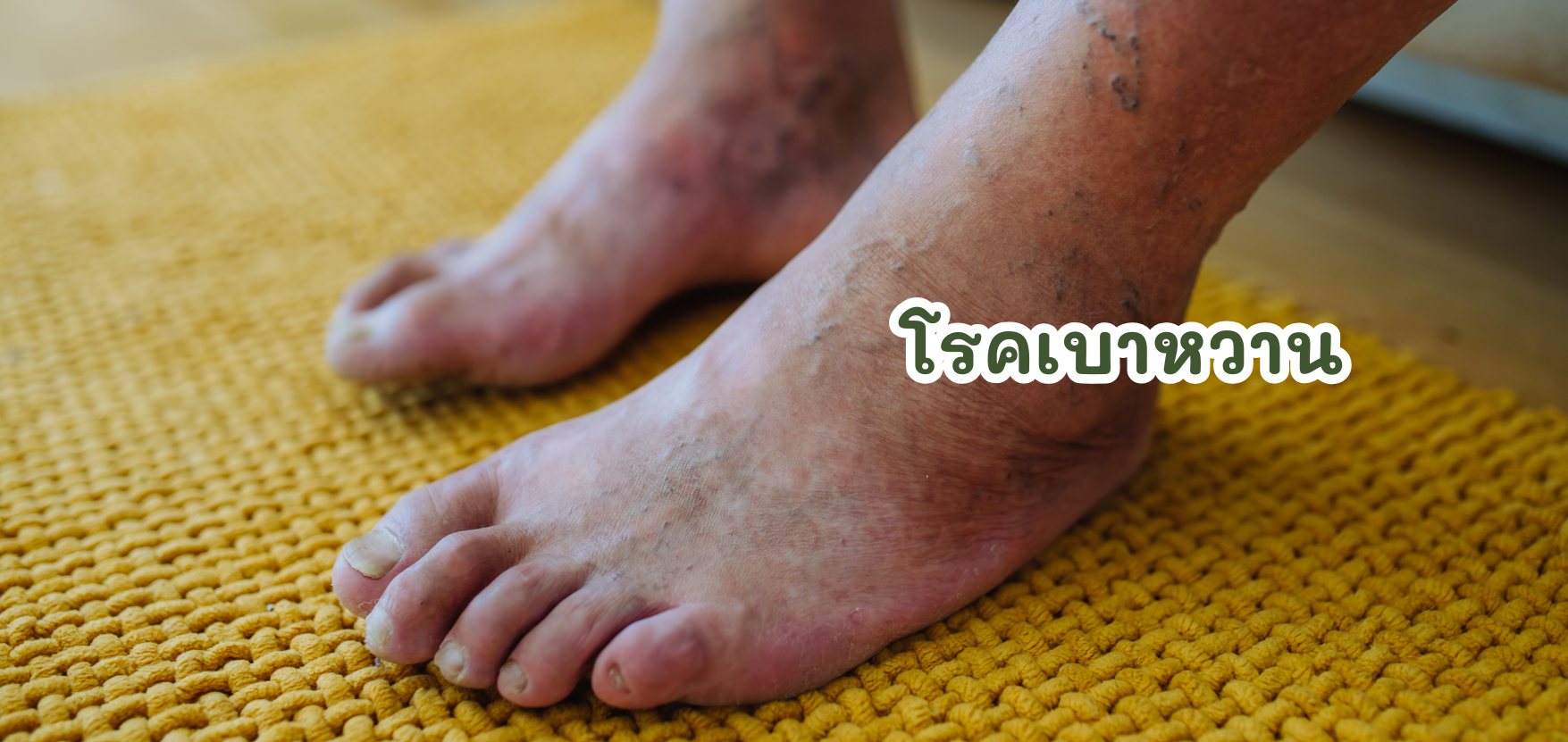 โรคเบาหวาน